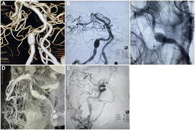 Flow diverters in the treatment of unruptured vertebral artery dissecting aneurysm: A single-center experience